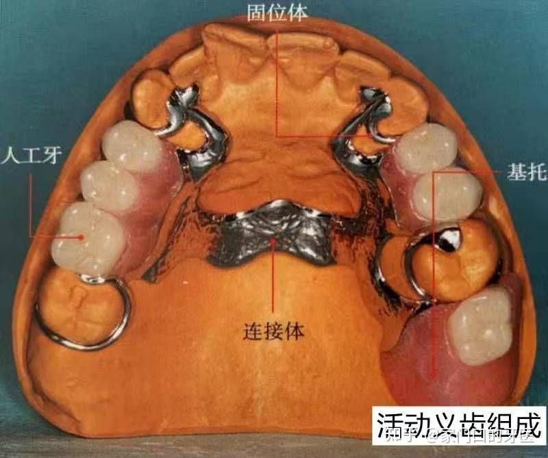 隐形义齿图片优缺点_单颗活动隐形义牙图片_隐形牙图片大全