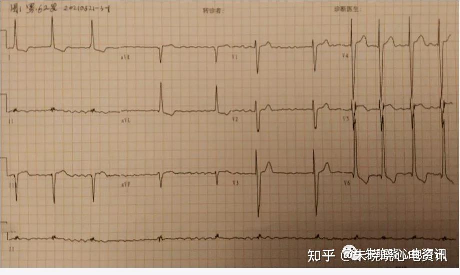 阵发性室上性心动过速的治疗_阵发性室性心动过_阵发性房性心动