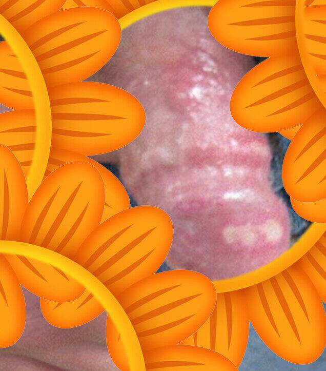 高ige综合症不得肺炎_高ige综合症能治愈吗_高ige综合症长大会改善吗