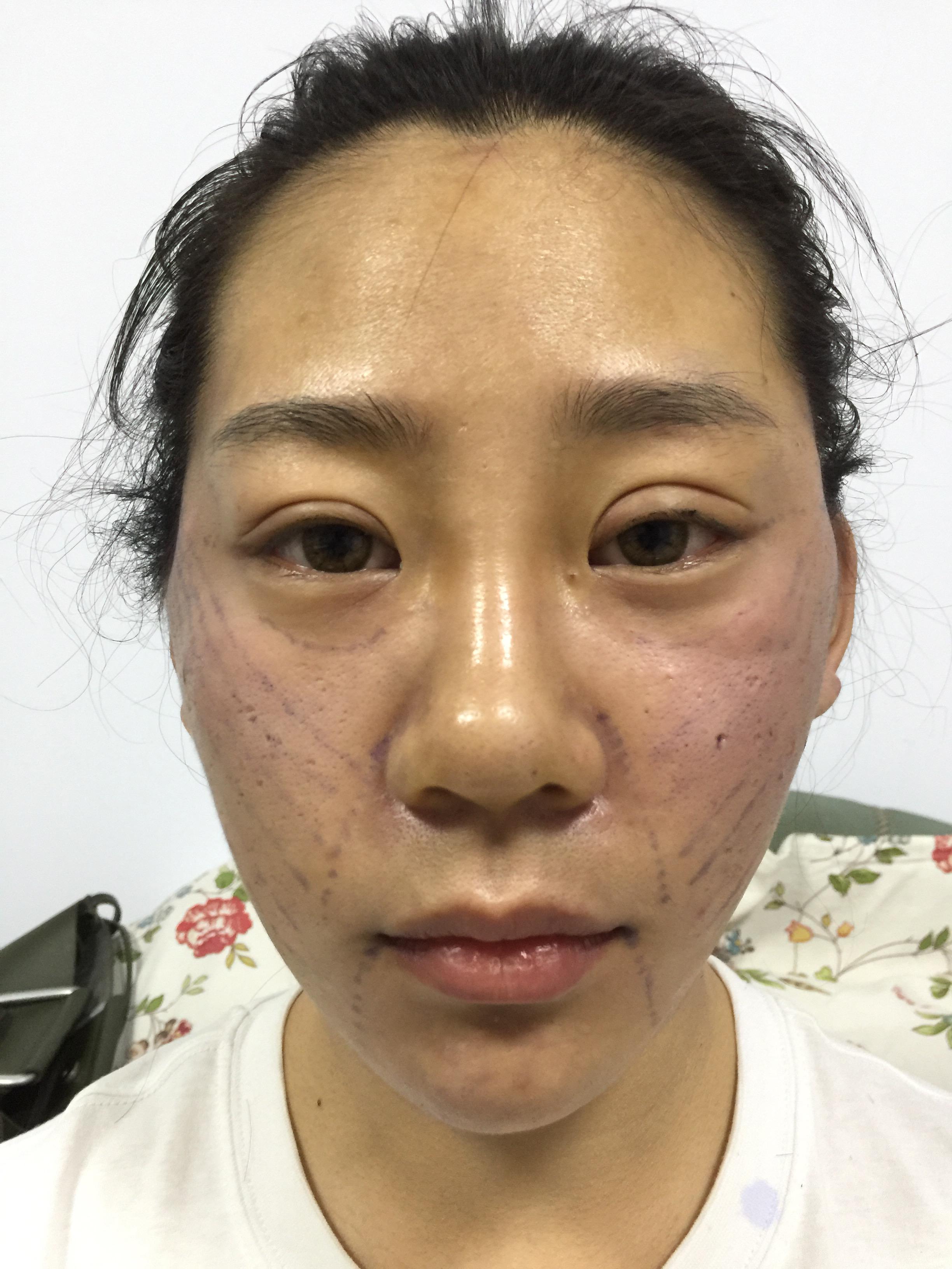 v脸提升针要打20多针-V 脸提升针：美丽背后的代价，20 