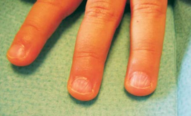 原因手指甲白点上有黑点_我手指甲上有白点什么原因_原因手指甲白点上有白色斑点