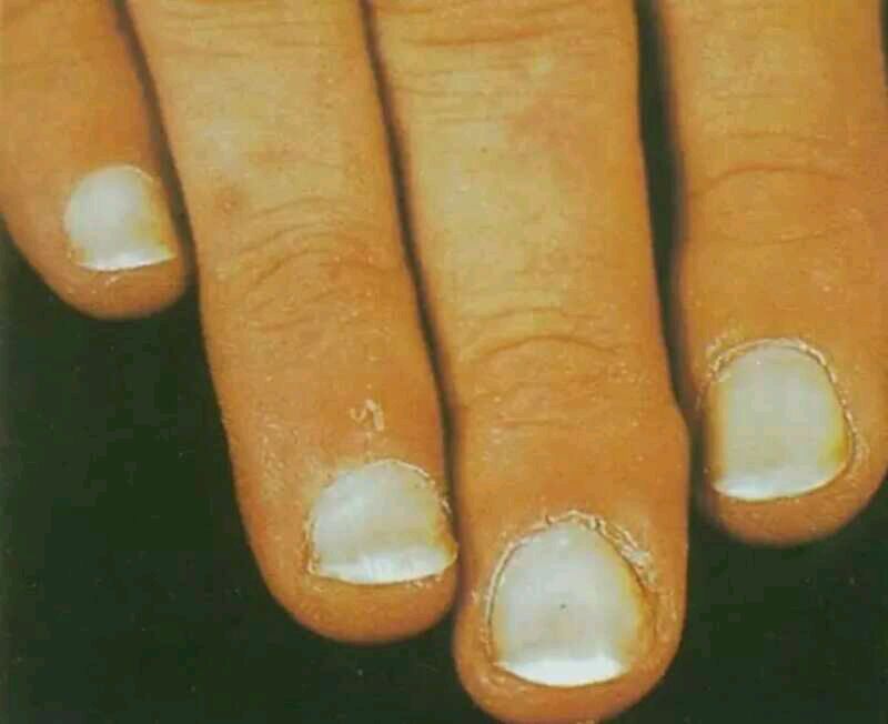 我手指甲上有白点什么原因_原因手指甲白点上有黑点_原因手指甲白点上有白色斑点