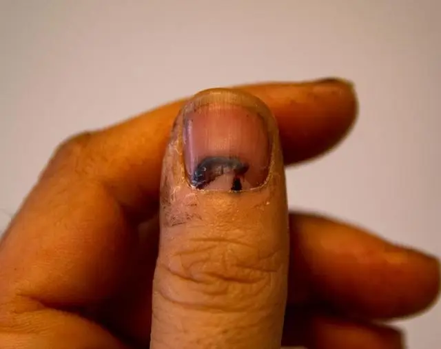 我手指甲上有白点什么原因_原因手指甲白点上有白色斑点_原因手指甲白点上有黑点