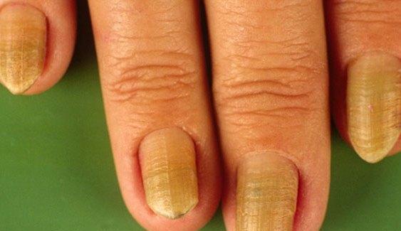 原因手指甲白点上有白色斑点_原因手指甲白点上有黑点_我手指甲上有白点什么原因