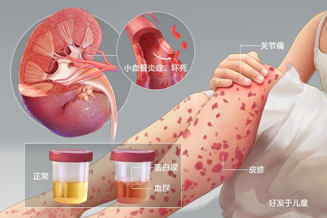 变态反应性疾病定义_变态病反应型代表分型有哪些_变态反应分型及代表病