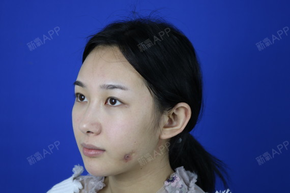 双眼术皮定位点后多久恢复_三点定位双眼皮术后_双眼皮定位后怎么护理